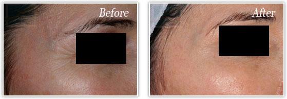 Botox result at Lupo Center for Aesthetic and General Dermatology in New Orleans, LA