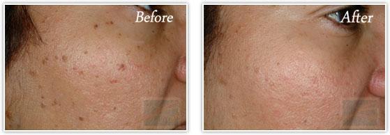 Laser Skin Resurfacing result at Lupo Center for Aesthetic and General Dermatology in New Orleans, LA