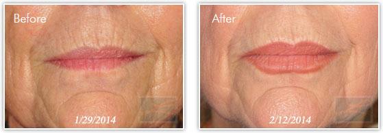 Lupo Center for Aesthetic and General Dermatology lip filler result — New Orleans, LA