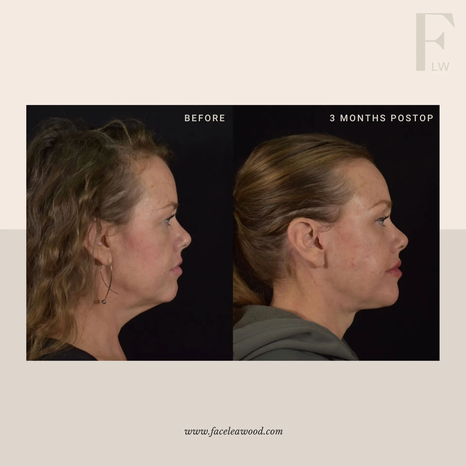 Dr. Lauren Umstattd facelift result — Leawood, KS
