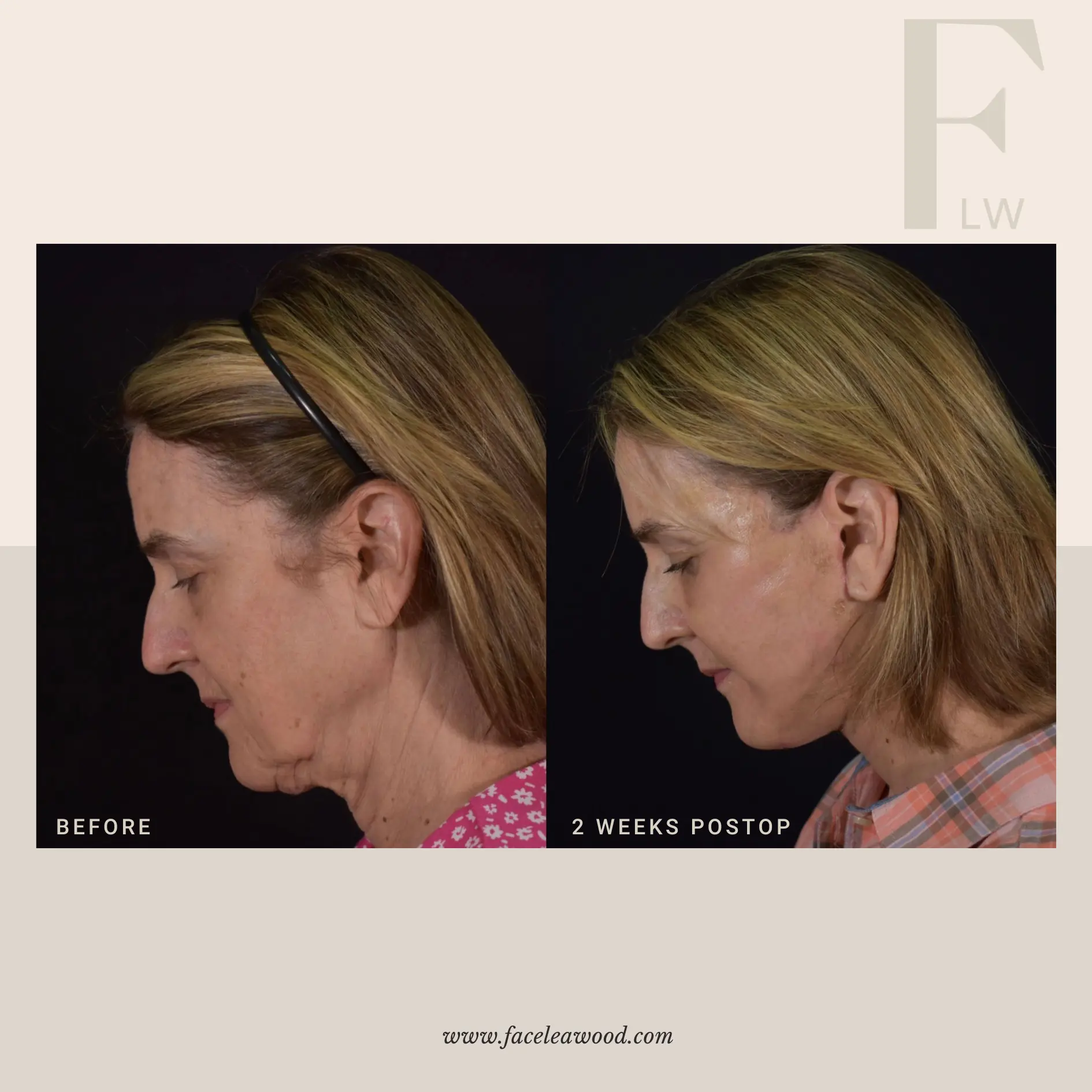 Dr. Lauren Umstattd facelift result — Leawood, KS