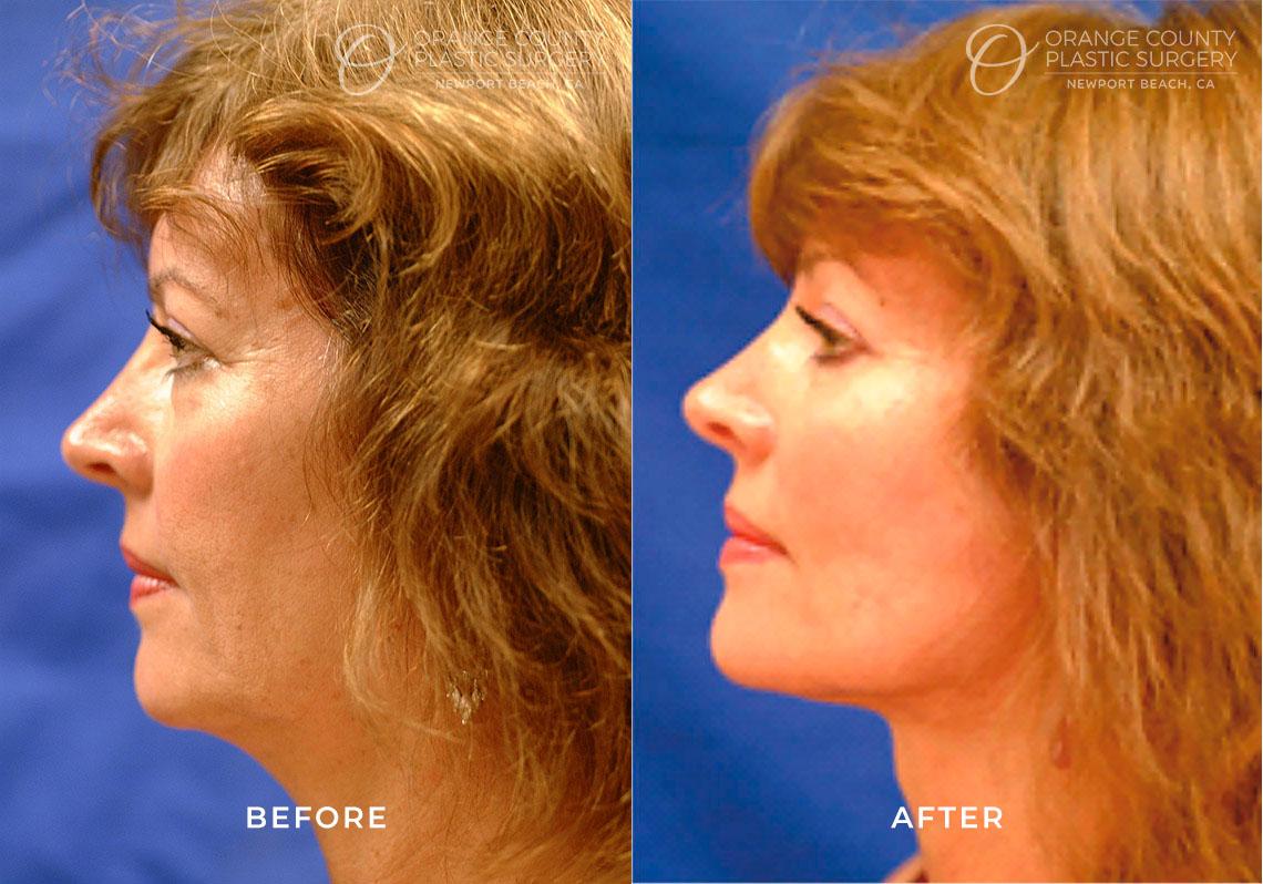 Orange County Plastic Surgery result — Newport Beach, CA
