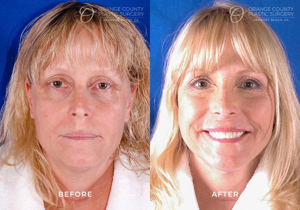 Orange County Plastic Surgery result — Newport Beach, CA