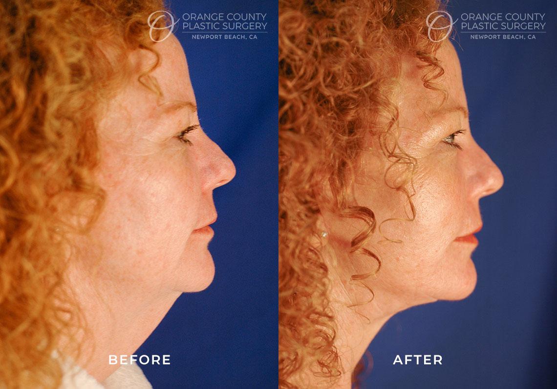 Orange County Plastic Surgery facelift result — Newport Beach, CA