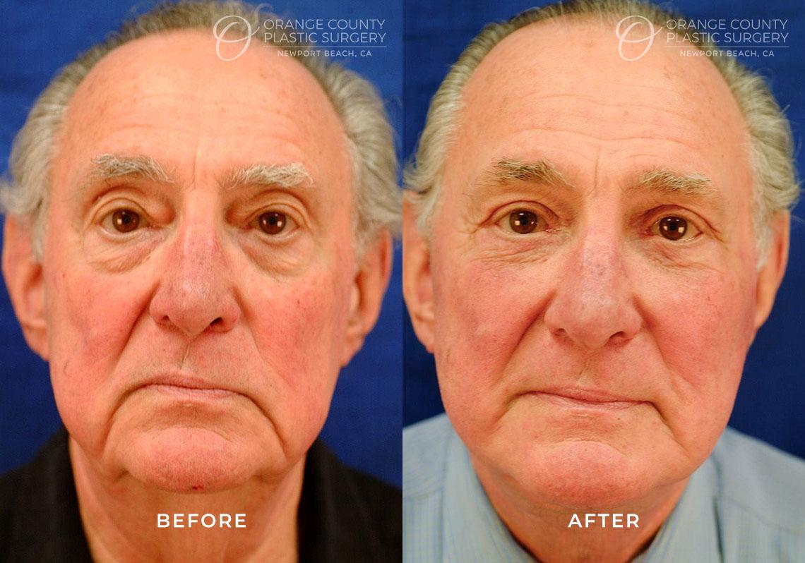 Orange County Plastic Surgery result — Newport Beach, CA