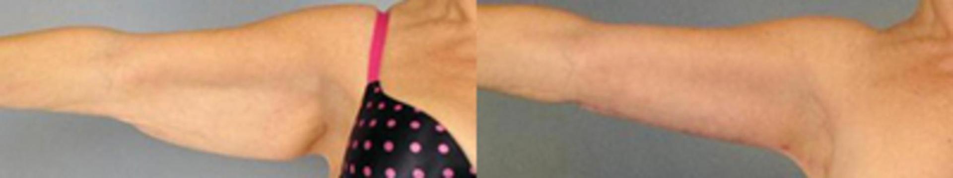 Germán Newall, MD arm lift result — Houston, TX