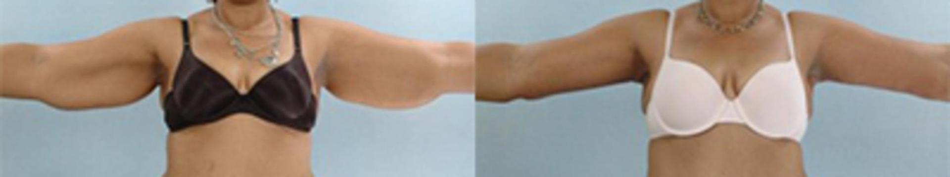 Germán Newall, MD arm lift result — Houston, TX