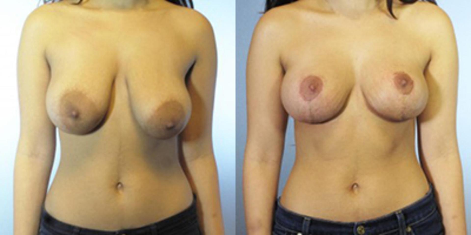 Germán Newall, MD breast lift result — Houston, TX
