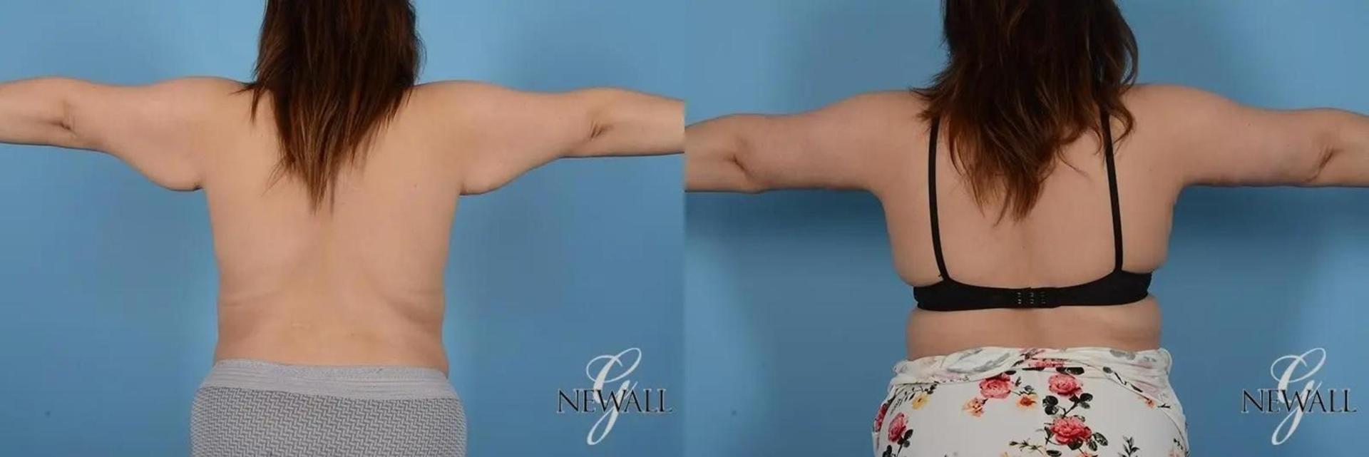 Germán Newall, MD arm lift result — Houston, TX