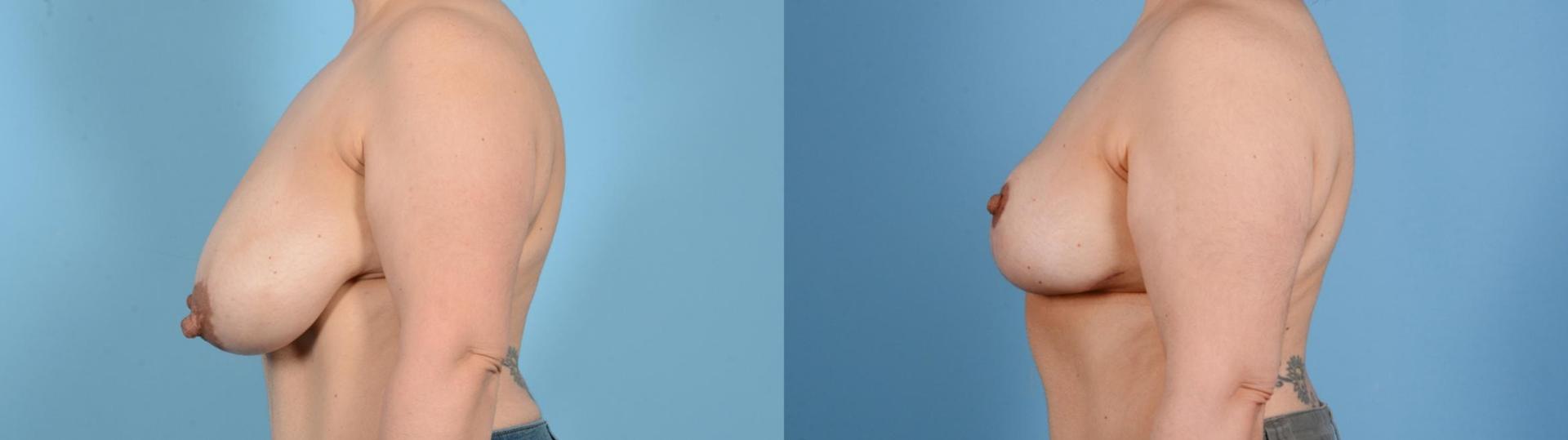 Germán Newall, MD breast lift result — Houston, TX