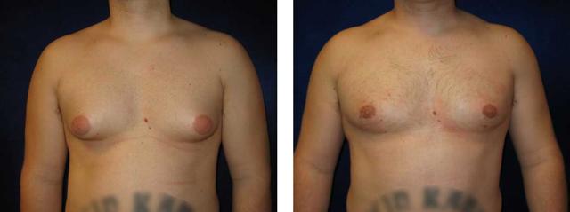 Gynecomastia Surgery result at Richard Zienowicz / bodybyZ Plastic Surgery in Providence, RI