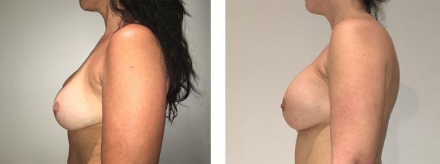 Breast Augmentation result at Richard Zienowicz / bodybyZ Plastic Surgery in Providence, RI