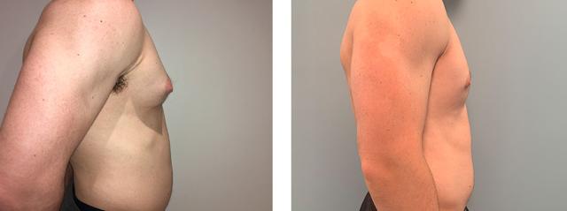 Gynecomastia Surgery result at Richard Zienowicz / bodybyZ Plastic Surgery in Providence, RI