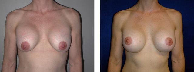 Breast Lift result at Richard Zienowicz / bodybyZ Plastic Surgery in Providence, RI