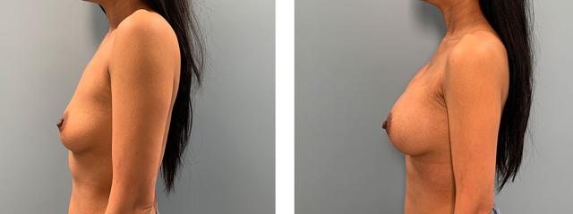 Fat Transfer Breast Augmentation result at Richard Zienowicz / bodybyZ Plastic Surgery in Providence, RI