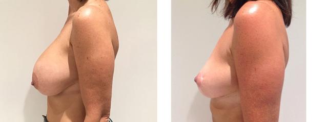 Breast Reduction result at Richard Zienowicz / bodybyZ Plastic Surgery in Providence, RI