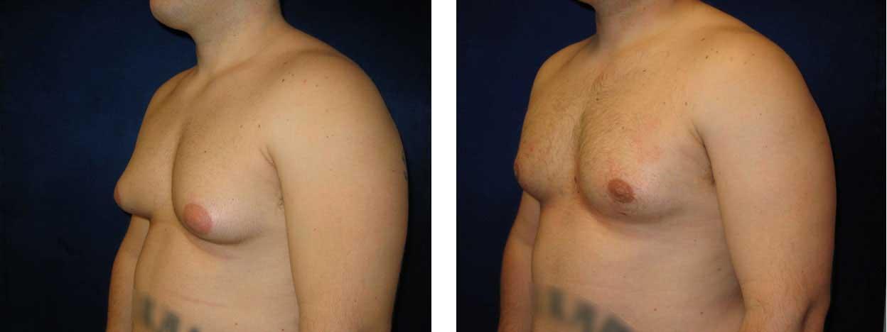 Richard Zienowicz / bodybyZ Plastic Surgery gynecomastia result — Providence, RI