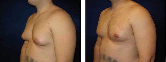 Gynecomastia Surgery result at Richard Zienowicz / bodybyZ Plastic Surgery in Providence, RI