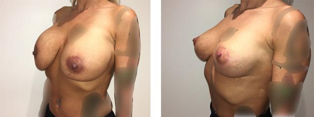 Breast Lift result at Richard Zienowicz / bodybyZ Plastic Surgery in Providence, RI