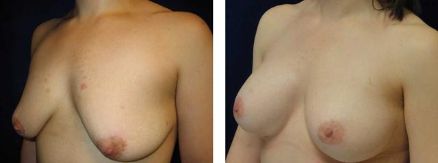 Breast Reduction result at Richard Zienowicz / bodybyZ Plastic Surgery in Providence, RI