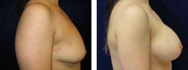 Breast Lift result at Richard Zienowicz / bodybyZ Plastic Surgery in Providence, RI