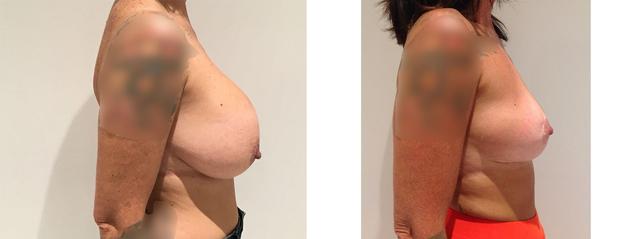 Breast Reduction result at Richard Zienowicz / bodybyZ Plastic Surgery in Providence, RI