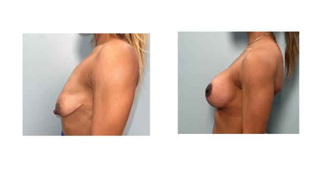 Fat Transfer Breast Augmentation result at Richard Zienowicz / bodybyZ Plastic Surgery in Providence, RI