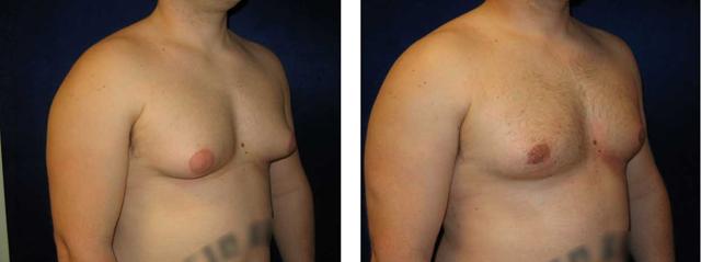 Gynecomastia Surgery result at Richard Zienowicz / bodybyZ Plastic Surgery in Providence, RI