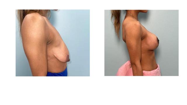 Breast Lift result at Richard Zienowicz / bodybyZ Plastic Surgery in Providence, RI