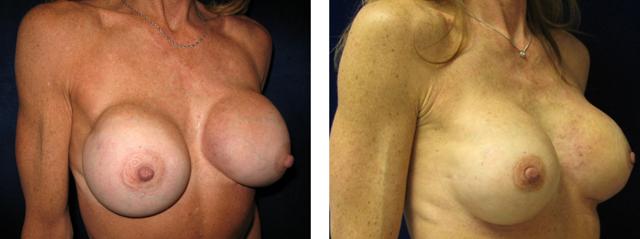 Breast Reduction result at Richard Zienowicz / bodybyZ Plastic Surgery in Providence, RI