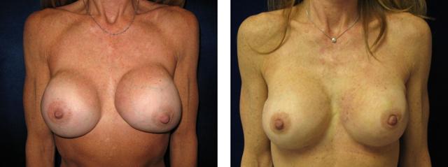 Breast Reduction result at Richard Zienowicz / bodybyZ Plastic Surgery in Providence, RI