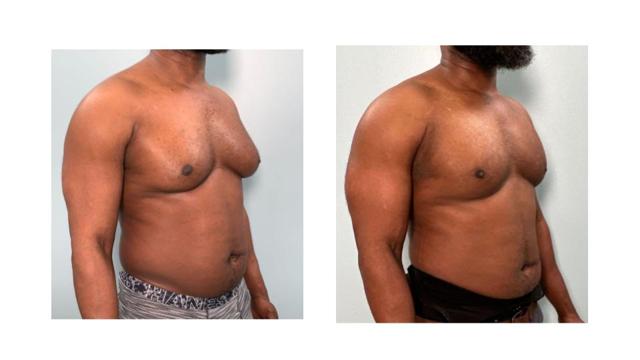 Gynecomastia Surgery result at Richard Zienowicz / bodybyZ Plastic Surgery in Providence, RI