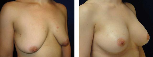 Breast Lift result at Richard Zienowicz / bodybyZ Plastic Surgery in Providence, RI