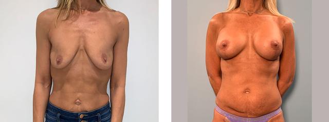 Breast Lift result at Richard Zienowicz / bodybyZ Plastic Surgery in Providence, RI