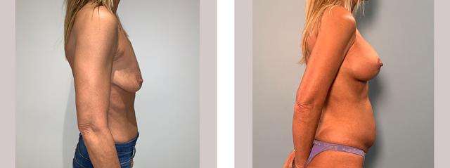 Breast Lift result at Richard Zienowicz / bodybyZ Plastic Surgery in Providence, RI