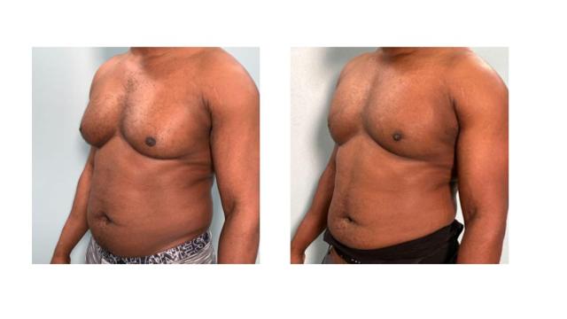 Gynecomastia Surgery result at Richard Zienowicz / bodybyZ Plastic Surgery in Providence, RI