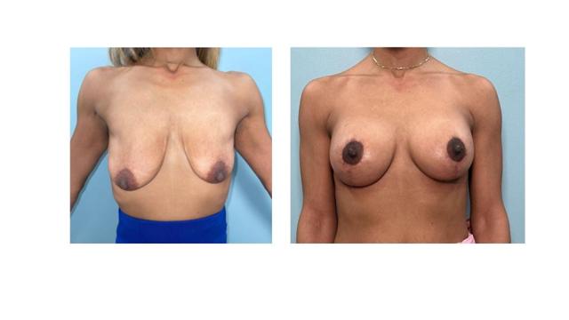 Breast Lift result at Richard Zienowicz / bodybyZ Plastic Surgery in Providence, RI