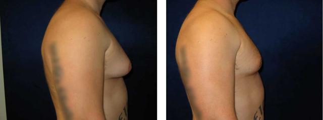 Gynecomastia Surgery result at Richard Zienowicz / bodybyZ Plastic Surgery in Providence, RI