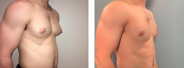 Gynecomastia Surgery result at Richard Zienowicz / bodybyZ Plastic Surgery in Providence, RI