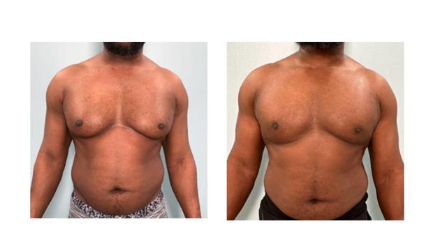 Gynecomastia Surgery result at Richard Zienowicz / bodybyZ Plastic Surgery in Providence, RI