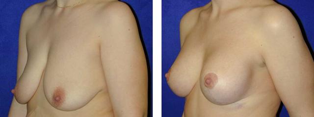 Breast Lift result at Richard Zienowicz / bodybyZ Plastic Surgery in Providence, RI