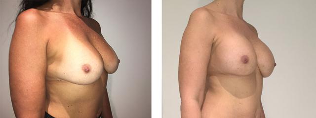 Breast Augmentation result at Richard Zienowicz / bodybyZ Plastic Surgery in Providence, RI