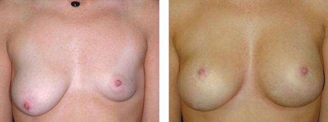Breast Lift result at Richard Zienowicz / bodybyZ Plastic Surgery in Providence, RI
