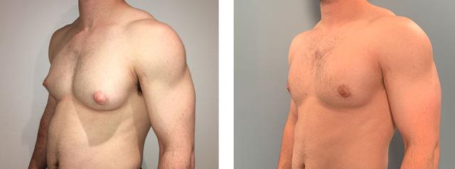 Gynecomastia Surgery result at Richard Zienowicz / bodybyZ Plastic Surgery in Providence, RI