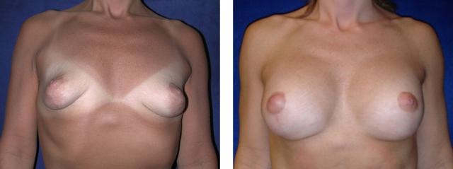 Breast Reduction result at Richard Zienowicz / bodybyZ Plastic Surgery in Providence, RI