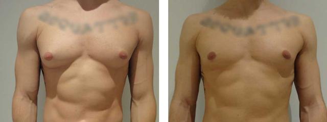 Gynecomastia Surgery result at Richard Zienowicz / bodybyZ Plastic Surgery in Providence, RI