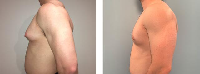 Gynecomastia Surgery result at Richard Zienowicz / bodybyZ Plastic Surgery in Providence, RI