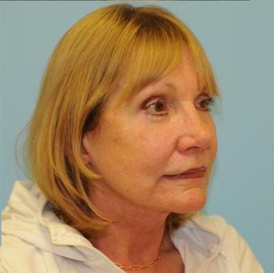 Berlet Plastic Surgery facelift after — Cedar Grove, NJ