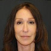 Berlet Plastic Surgery facelift after — Cedar Grove, NJ