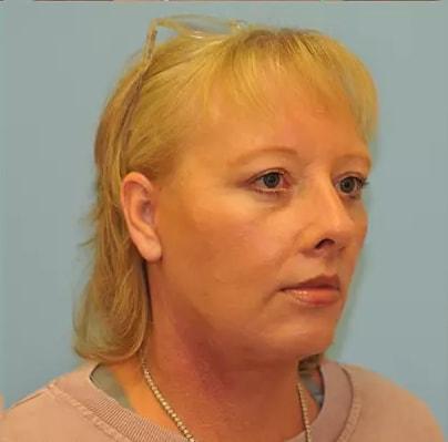 Berlet Plastic Surgery facelift after — Cedar Grove, NJ
